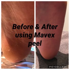 Mavex Peel